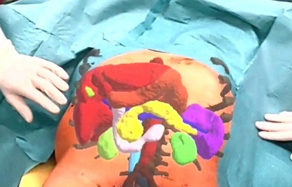 Sala operatoria e realtà virtuale: un ologramma tridimensionale del fegato ricostruito con i dati della Tac